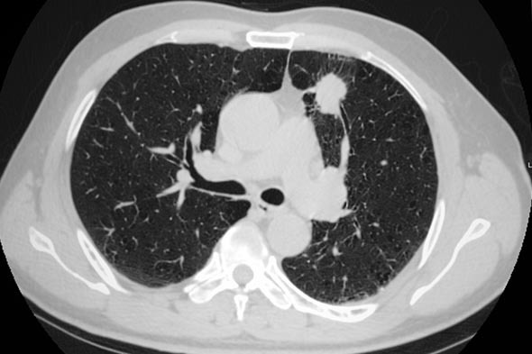 Diagnostic and Prognostic Biomarkers for Chronic Fibrosing Interstitial Lung Diseases