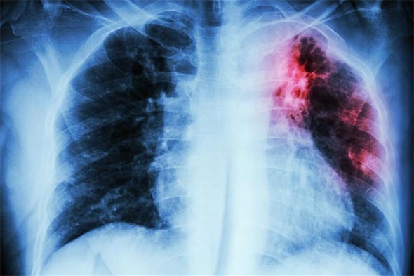 Interstitial Lung Disease: Overcoming the Drivers of Poor Outcomes