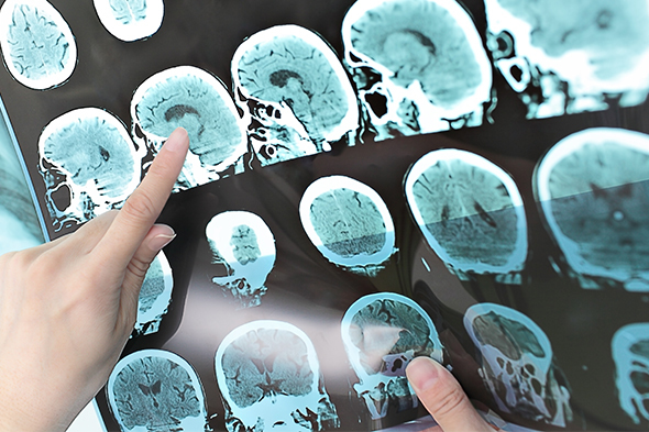 Recent Advances in Multiple Sclerosis