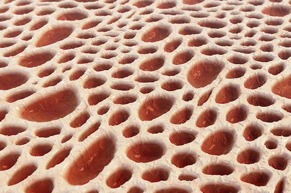 Minimal Residual Disease Testing in Multiple Myeloma