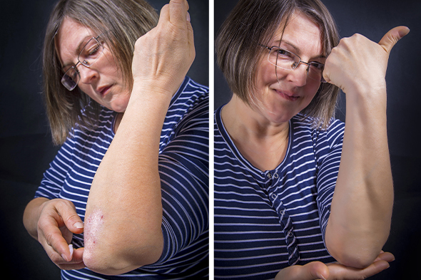 Defining Success in Psoriasis Care: Treatment Expectations and Clinical Goals