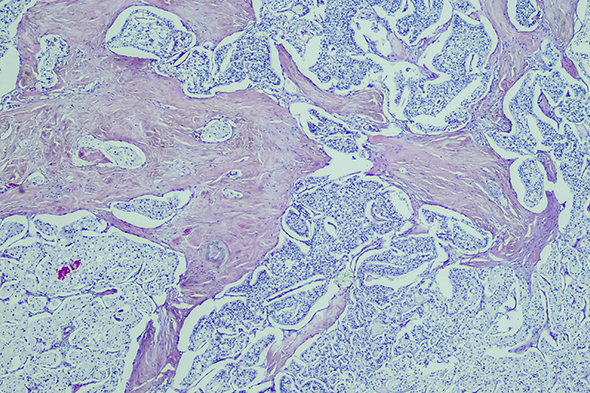 Conference Reporter in GEP-NETs to Cover Key Topics Being Presented at the 2023 NANETS Multidisciplinary NET Medical Symposium