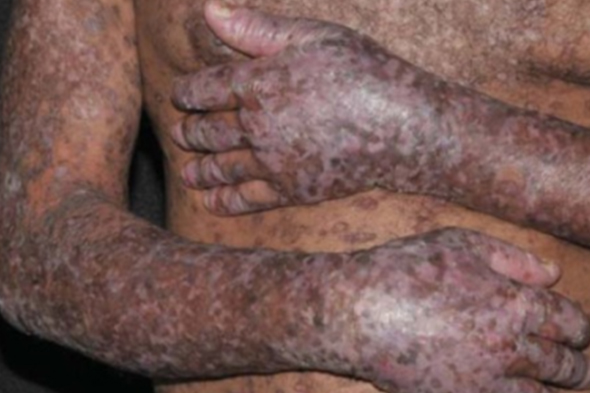 Approach to Steroid-Refractory Chronic Graft-versus-Host Disease