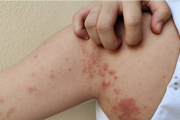 Atopic Dermatitis in Adults vs Children