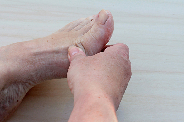 Challenges in the Treatment of Palmoplantar Psoriasis