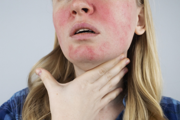 Cutaneous Manifestations in Systemic Lupus Erythematosus