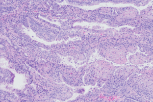 Predicting Endometrial Cancer Recurrence and Response to Adjuvant Therapy