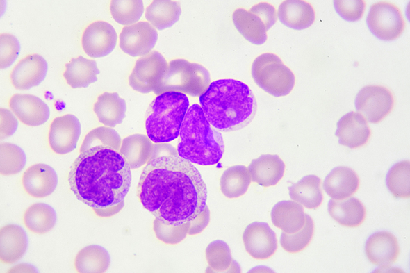 Late-line Treatment in Chronic-Phase Chronic Myeloid Leukemia