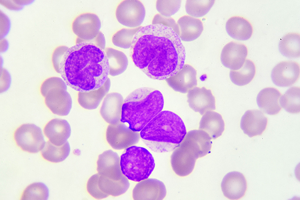 Tolerability of Tyrosine Kinase Inhibitors in Chronic Myeloid Leukemia