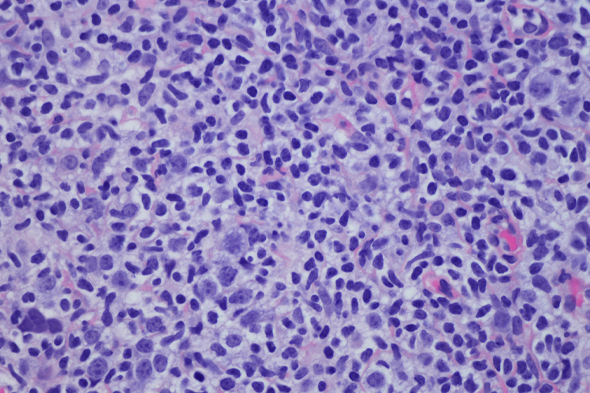 Role of Bruton Tyrosine Kinase in B-Cell Tumorigenesis