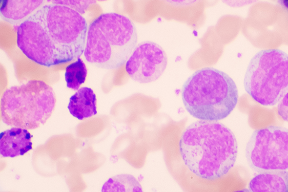 Minimal Residual Disease–Guided, Time-Limited Therapy for Chronic Lymphocytic Leukemia