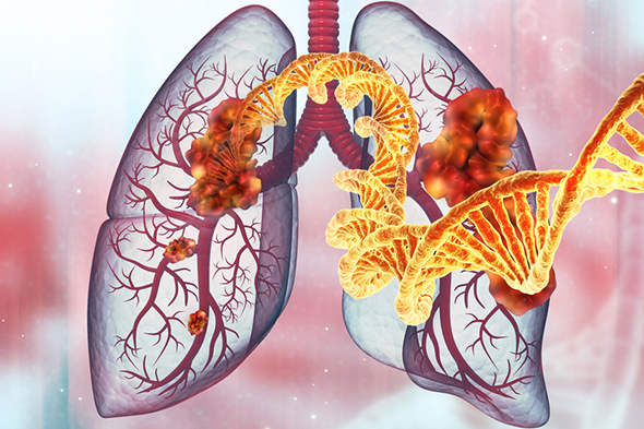 Advances in Non–Small Cell Lung Cancer: Circulating Tumor DNA–Guided Therapy
