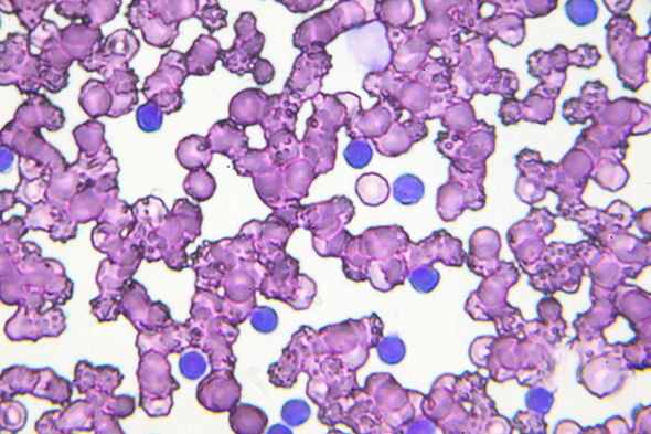 Frontline Therapy for Chronic Lymphocytic Leukemia: The Evolving Paradigm