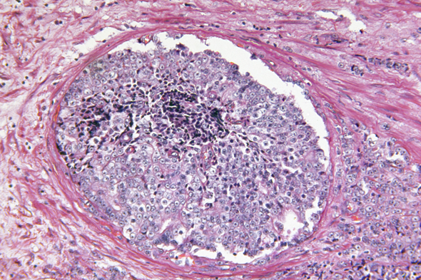 Monitoring for the Transition From Nonmetastatic Castration-Resistant Prostate Cancer to Detectable Metastatic Disease