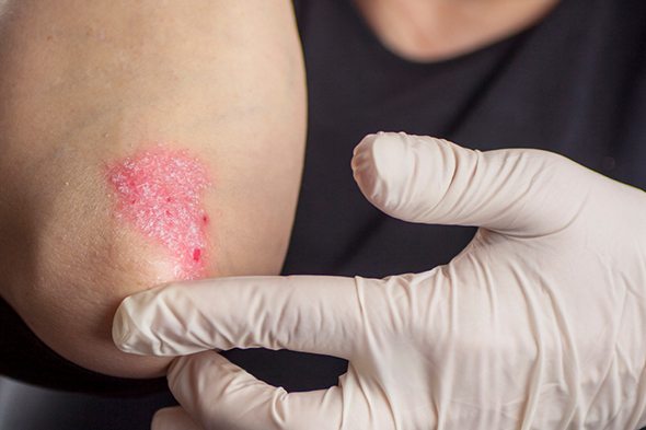 Real-World Experience With IL-17 and IL-23 Inhibitors for Plaque Psoriasis