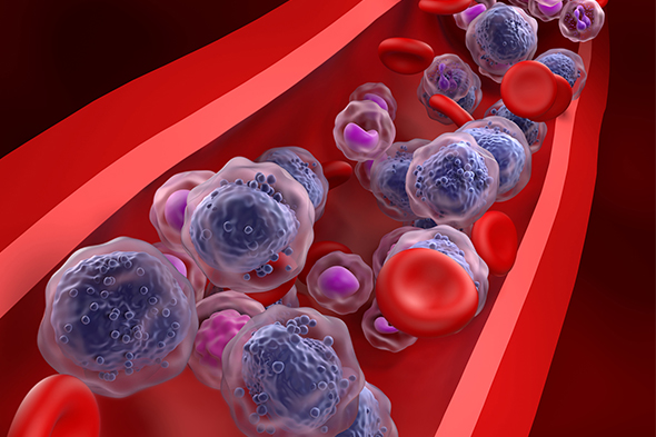 Maintenance Therapy Post Allogeneic Stem Cell Transplantation in AML