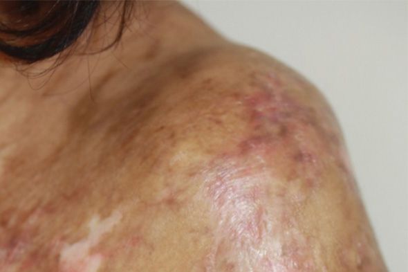 Chronic Graft-versus-Host Disease: Clinical Application of Regulatory T Cells