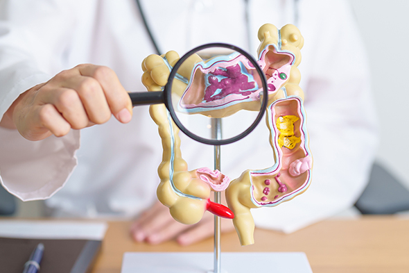 Expert Perspectives in Ulcerative Colitis to Cover Key Topics in Ulcerative Colitis Treatment