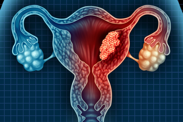 Recent Analyses From Clinical Trials in Advanced Endometrial Cancer